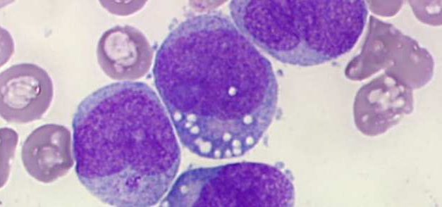Posible vía para derrotar a la leucemia mieloide aguda