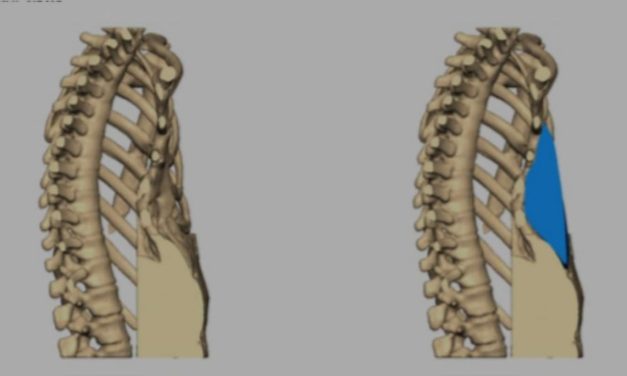 LA TECNOLOGÍA 3D OFRECE SOLUCIONES PARA LA ENFERMEDAD DEL “PECHO HUNDIDO”