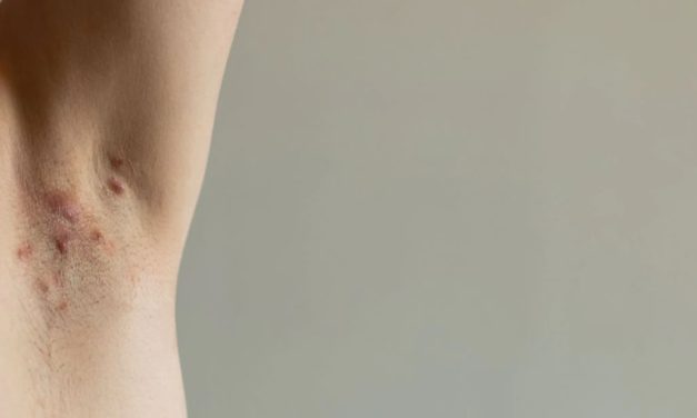 DETECCIÓN GRATUITA DE UNA DOLOROSA ENFERMEDAD QUE SE MANIFIESTA EN LA PIEL