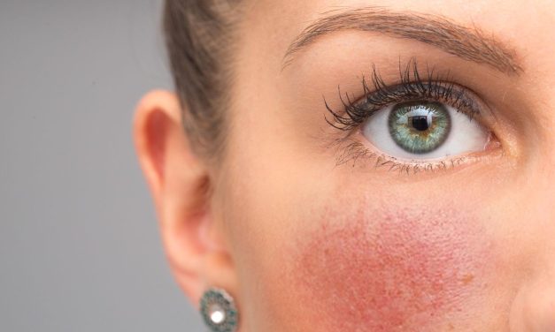 Síntomas y tratamientos para la rosácea, una enfermedad incómoda que inflama y enrojece la piel