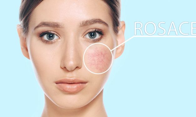 Las ocho cosas que hay que evitar si se tiene rosácea