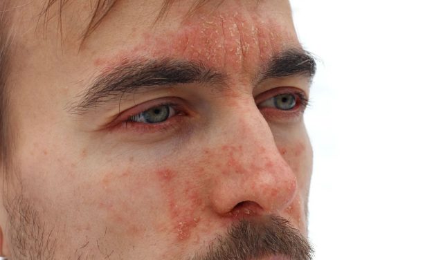 La psoriasis, una enfermedad que tiene impacto en la salud mental de los argentinos