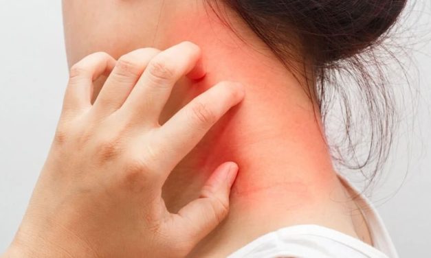 CAMPAÑA DE DETECCIÓN GRATUITA DE DERMATITIS ATÓPICA