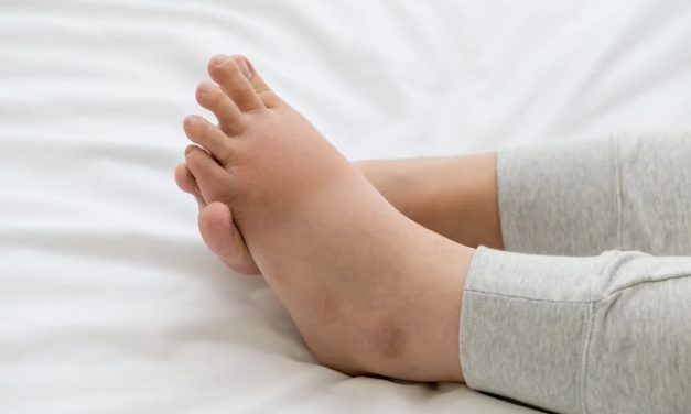 Cómo detectar y evitar la retención de líquidos