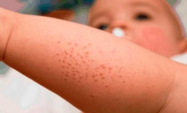 Cerca del 85 por ciento de los pacientes con dermatitis atópica debe afrontar gastos adicionales en su tratamiento