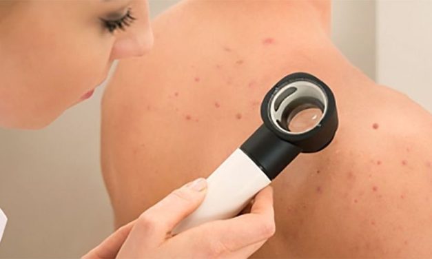 CAMPAÑA DE DETECCIÓN GRATUITA  ¿QUÉ ES LA HIDRADENITIS SUPURATIVA Y CÓMO IMPACTA EN LAS PERSONAS?