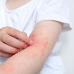 CAMPAÑA DE DETECCIÓN GRATUITA  DE DERMATITIS ATÓPICA