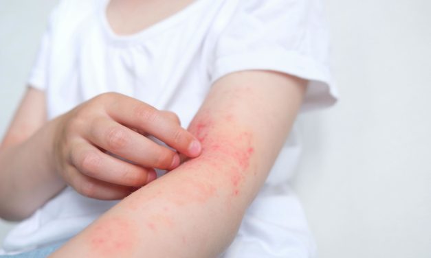 CAMPAÑA DE DETECCIÓN GRATUITA  DE DERMATITIS ATÓPICA