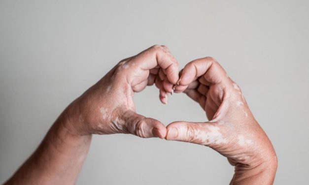 Día Mundial del Vitiligo: Cuál es su diagnóstico, tratamiento y cómo vivir con esta enfermedad