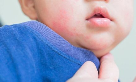 Lanzan una campaña nacional para detectar la alergia alimentaria más frecuente en bebés