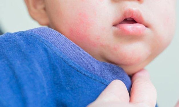 Lanzan una campaña nacional para detectar la alergia alimentaria más frecuente en bebés