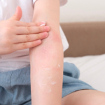 14 de septiembre, Día Mundial de la Dermatitis Atópica: por qué la picazón persistente no debería normalizarse
