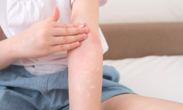 14 de septiembre, Día Mundial de la Dermatitis Atópica: por qué la picazón persistente no debería normalizarse